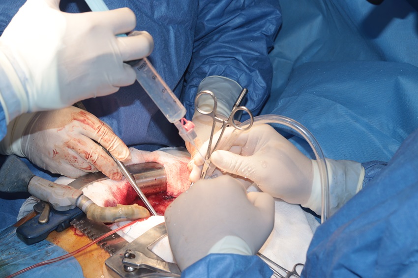 جراحة تصليح الشرايين التاجية